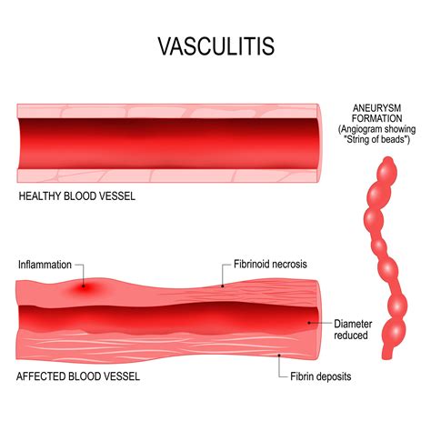 Vasculite Classificazione Sintomi E Cure Ohga