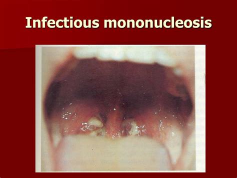 Ppt Infectious Diseases With Tonsillitis Diphtheria Powerpoint