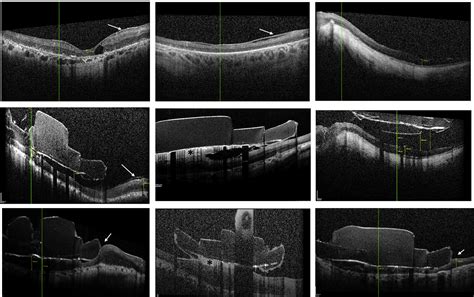 Retinal Anatomy And Electrode Array Position In Retinitis Pigmentosa