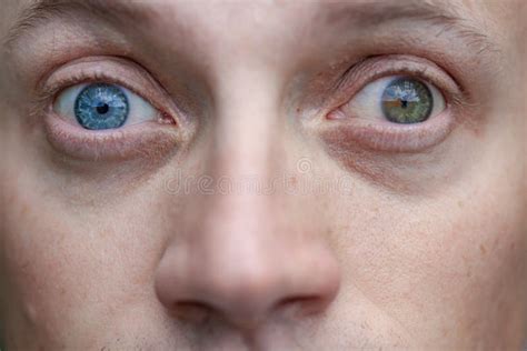 Full Face Close Up Photo Of Wide Opened Eyes Man With Strabismus And