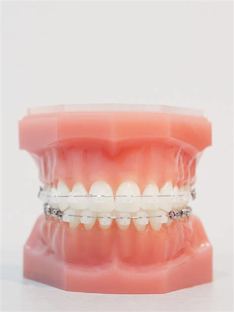 Ceramic Braces Model Booth Orthodontics