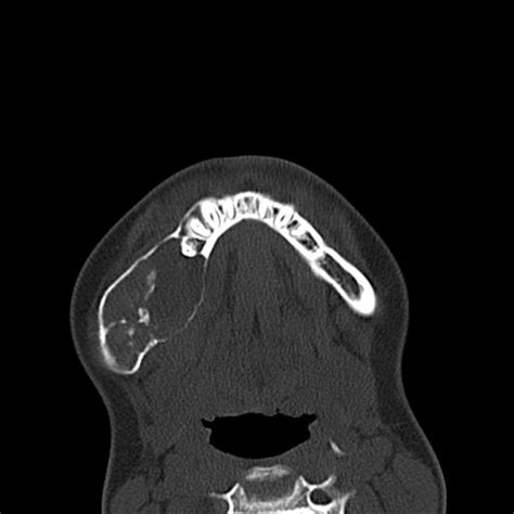 Aneurysmal Bone Cyst Of The Mandible Radiopaedia 43280 46601 Axial