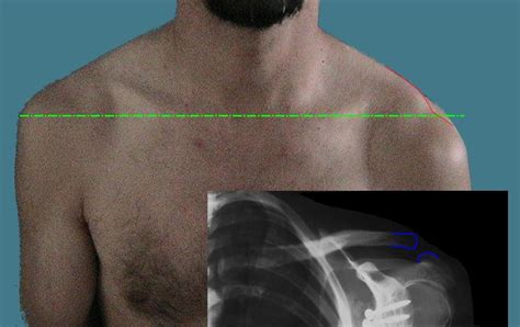Shoulder Conditions And Considerations