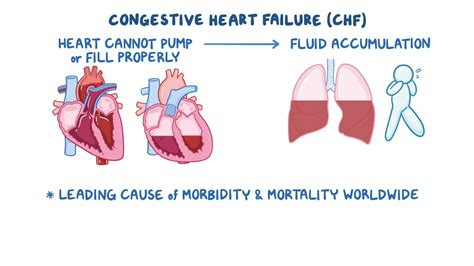 Congestive Heart Failure Clinical Sciences Osmosis Video Library