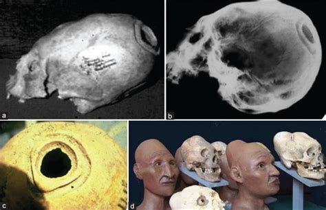 (a-c) Artificial cranial deformation with a left parietal healed... | Download Scientific Diagram