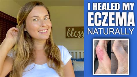 How I Healed My Eczema Psoriases Naturally YouTube