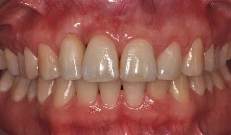 Surgical Treatment In A Patient With Severe Chronic Periodontitis A