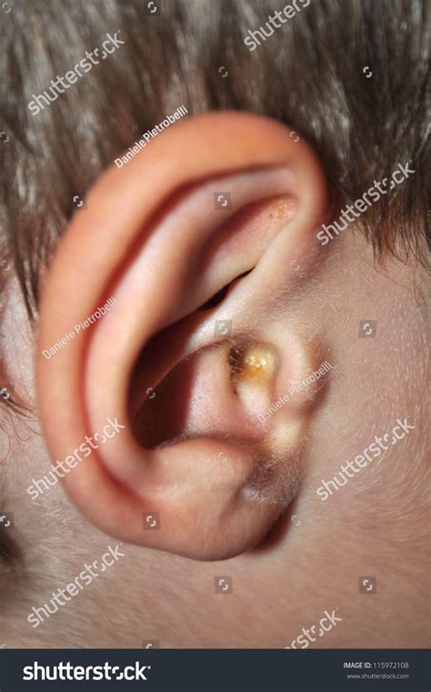 Earwax In The Dirty Ear Of A Child Stock Photo 115972108 Shutterstock