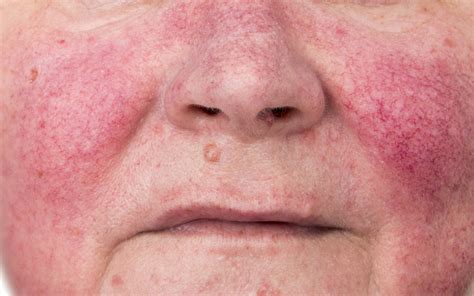 Rosacea Treatment — Hunter Coast Dermatology & Laser | Newcastle