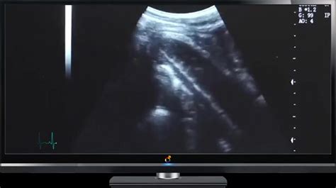Sex With Ultrasound