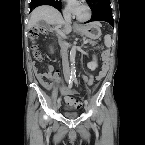Ct Scan Showing Stomach Cancer Photograph By Dr P Marazziscience