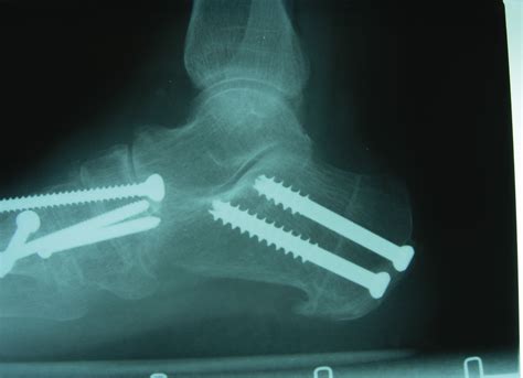 A Closer Look At The Percutaneous Calcaneal Displacement Osteotomy