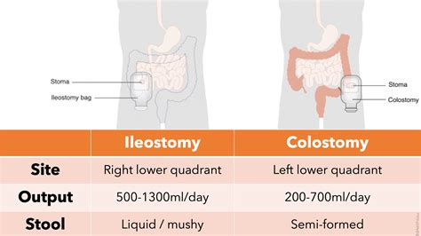 Diferença Entre Colostomia E Ileostomia Dashgoo