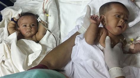 Bangladeshi Conjoined Twins Going Home 18 Months After Being Separated