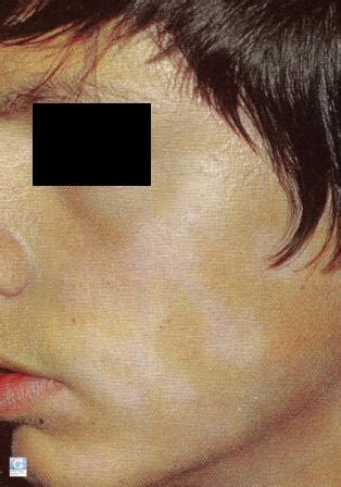 Citratus essential oil (1.25 mcl/ml concentration) in patients with pityriasis versicolor. Weiße Flecken bei Kindern (Deutsch) « Globale Dermatologie