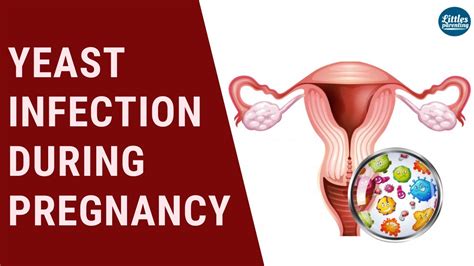 yeast infections during pregnancy symptoms treatment and prevention youtube