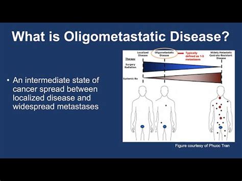 Management Of Oligometastatic Prostate Cancer From Imaging To Therapy YouTube