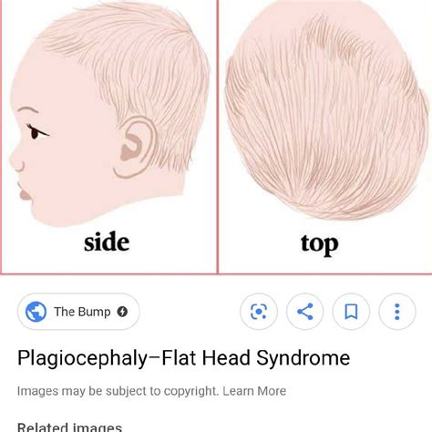What Is Flat Head Syndrome Firstcry Parenting