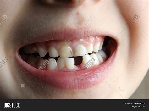 Child Missing Tooth Image And Photo Free Trial Bigstock