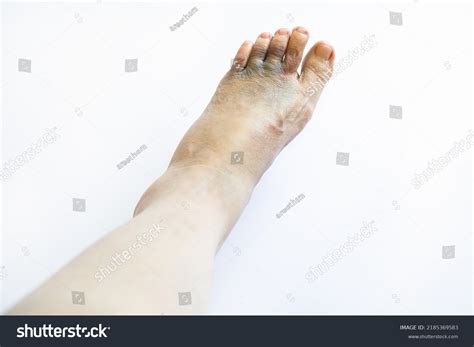 Left Foot Bruise Contusion Swollen Cause Stock Photo Shutterstock
