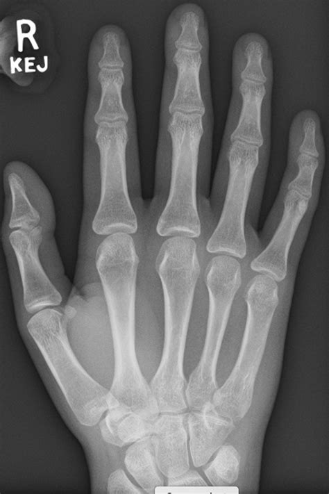 Osteoarthritis On An X Ray Fife Virtual Hand Clinic