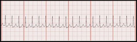 Float Nurse: Practice EKG Rhythm Strips 118