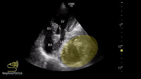 Hiatal Hernia On Focused Cardiac Ultrasound Nephropocus