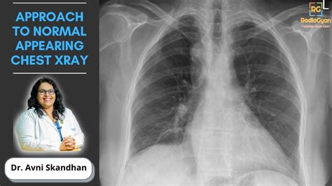Approach To An Unremarkable Chest X Ray Dr Avni Skandhan Youtube