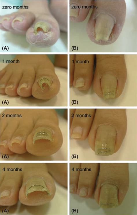 Figure 4 From A Simple Therapeutic Approach To Pincer Nail Deformity