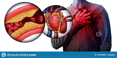 Myocardial Infarction Human Heart Disease Stock