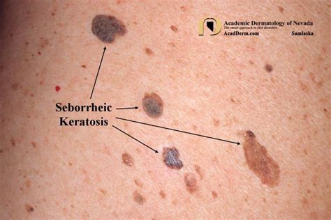 Seborrheic Keratosis Barnacles Of Life Academic Dermatology Of Nevada