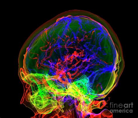 Brain Blood Vessels Photograph By K H Fungscience Photo Library Fine