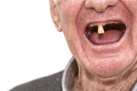 Tooth Loss And Ageing Not As Straight Forward As You Think