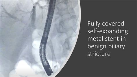 Ercp Fully Covered Self Expanding Metal Stent Fc Sems In Benign