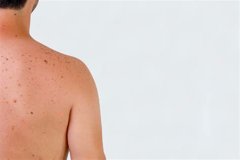 Sun Spots Conditions Treatment Brigstock Skin And Laser