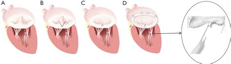 Illustrations Showing Resection Technique Of Mitral Valve Repair