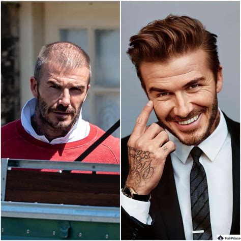 Best Celebrity Hair Transplant Before And After In 2024
