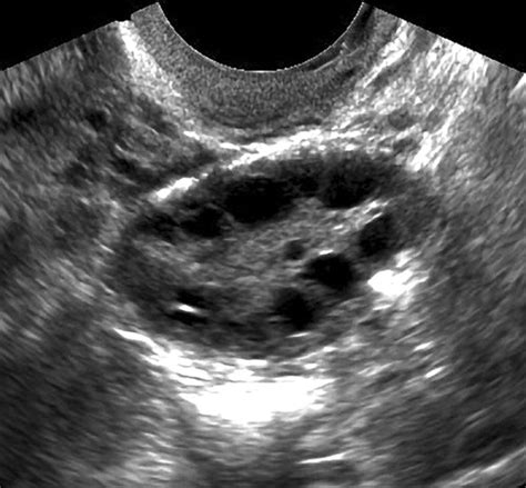 Ruptured Ovarian Cyst Ultrasound