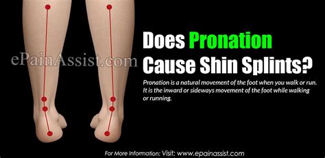Does Pronation Cause Shin Splints