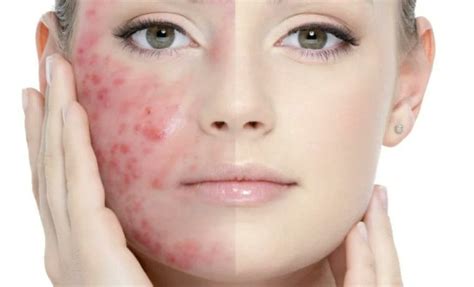 Breaking The Cycle The Latest Advances In Acne Vulgaris Treatment