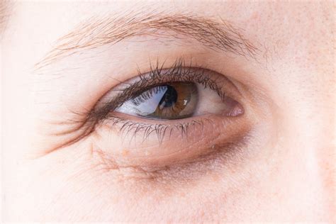 9 Causes Of Dark Eye Circles Take Action To Reduce Dark Circles Under