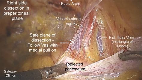 Laparoscopic Inguinal Hernia Repair Surgical Anatomy World Surgery Forum