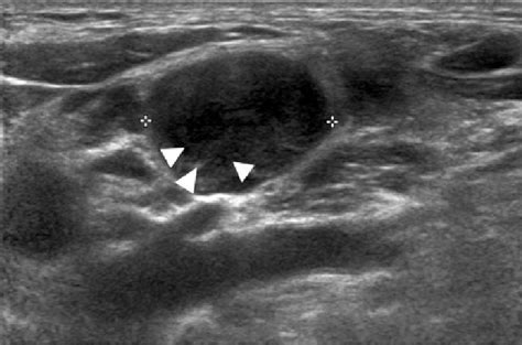 Supraclavicular Lymph Nodes Ultrasound Ultrasound Of Superficial