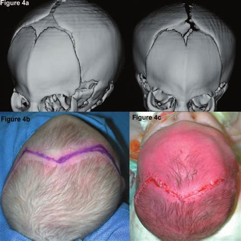 Schematic Overview Of The Most Common Types Of Craniosynostosis