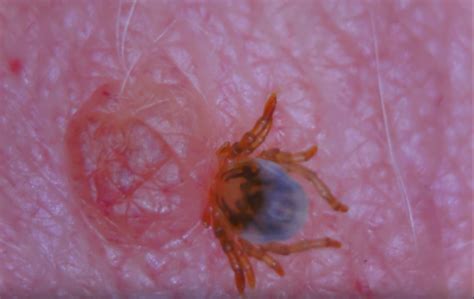 Can A Tick Bury Itself Under The Skin Rankiing Wiki Facts Films