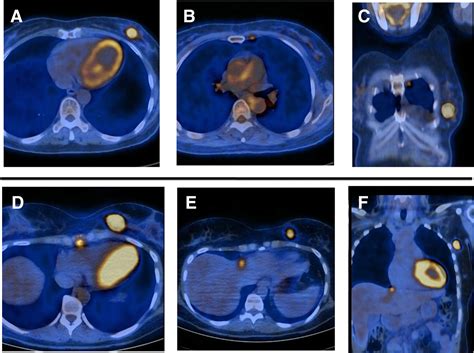 The Yield Of 18f Fdg Petct In Patients With Clinical Stage Iia Iib