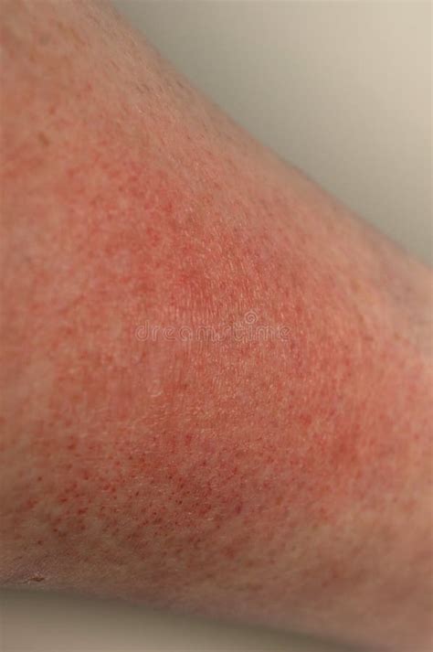 Photodermatosis Stock Photos Free And Royalty Free Stock Photos From