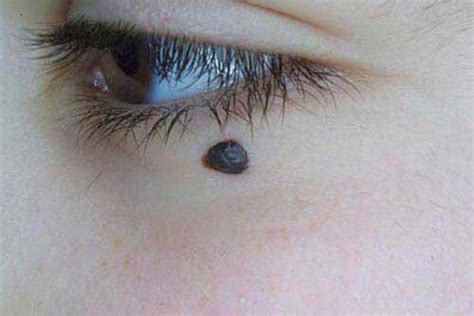 They are a bit like gap 1 or g1 phase, where the cell grows in size, and checks that everything is ok for it to divide. What causes moles? - What causes this?