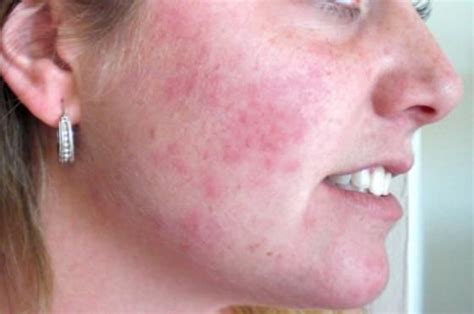 Home Remedies To Treat Rashes On Face Face Rash Remedies Rashes