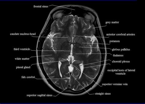 Myopathy with satellite cell loss thigh common: MRI anatomy brain axial image 14 | MRI | Pinterest | Radiology